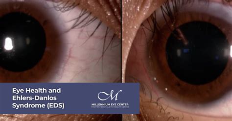 Eds And Eyes