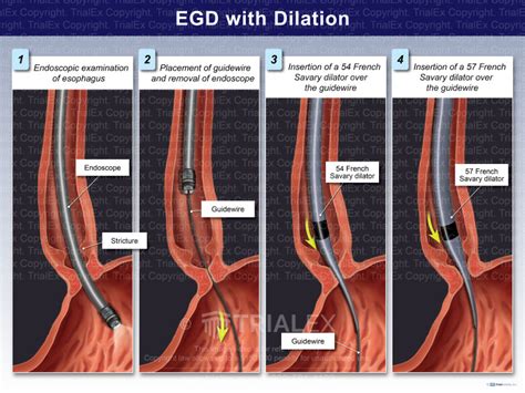 Egd With Biopsy