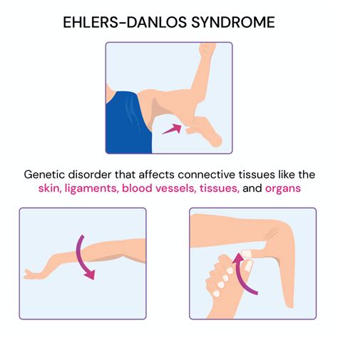 Ehlersdanlos Syndrome Test At Home