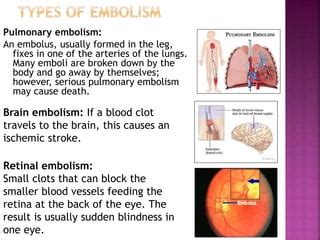 Embolio In English