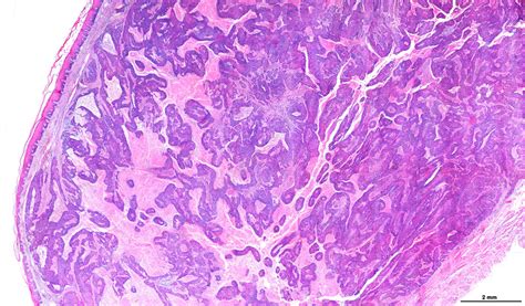 Epidermoid Carcinoma Mouth