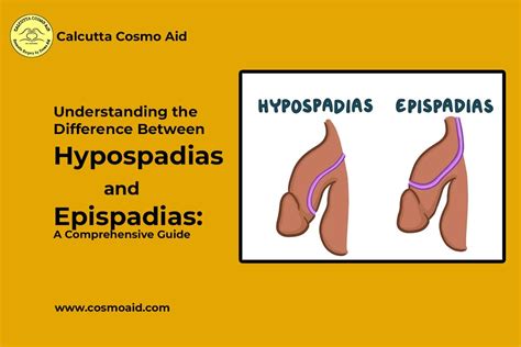 Epispadias Vs Hypospadias