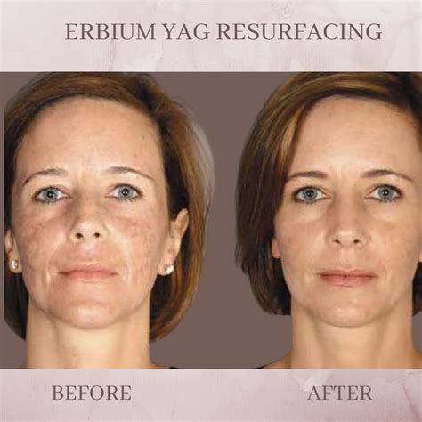 Erbium Laser Resurfacing