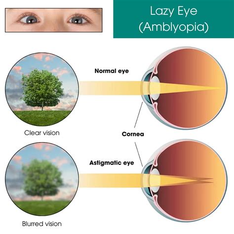 Eye Drops For Lazy Eye