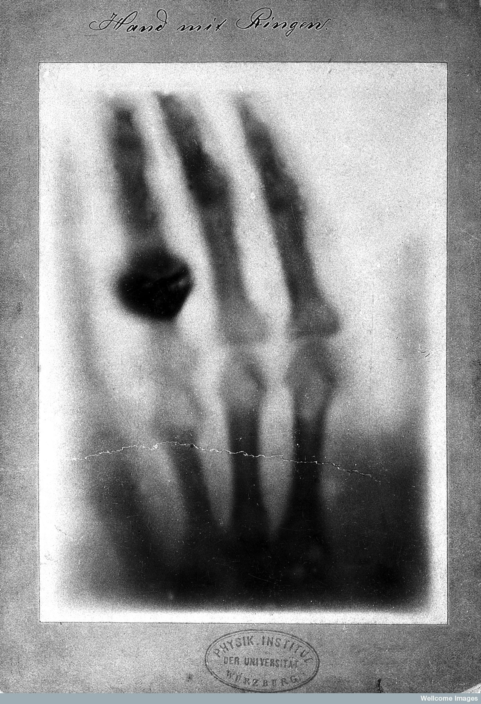 The First Known Xray: A Deep Dive Into Roentgen’s Discovery