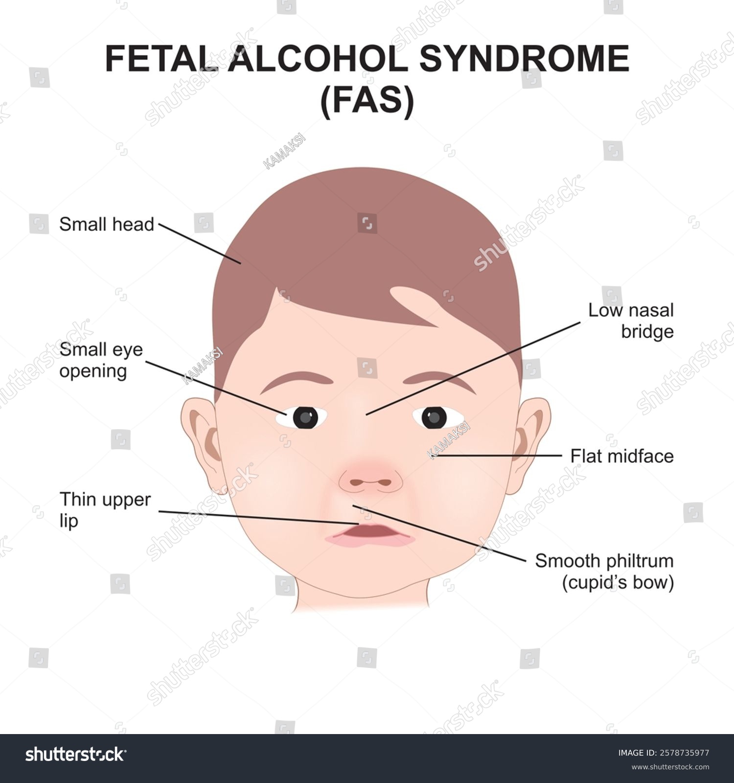 Foetal Scalp Electrode