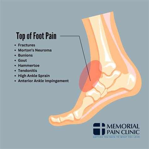 Foot Pain Top Of Foot