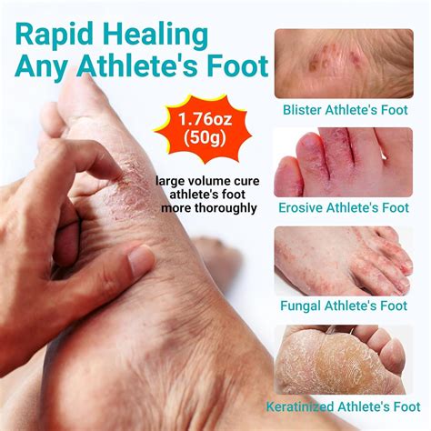 Foot Tinea Home Remedies