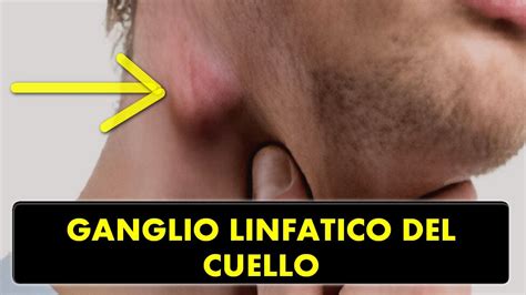 Glandulos Linfaticos Inflamados