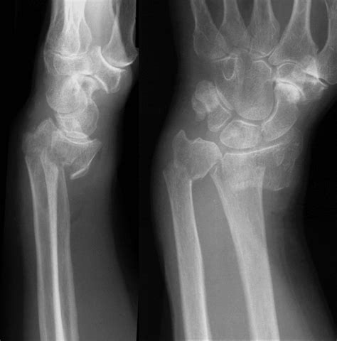 Goyrand Smith Fracture