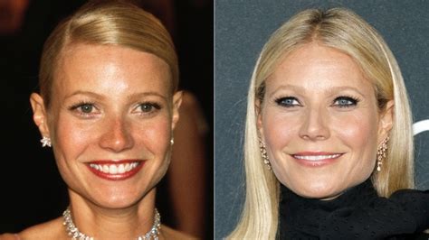Gwyneth Paltrow Face Surgery