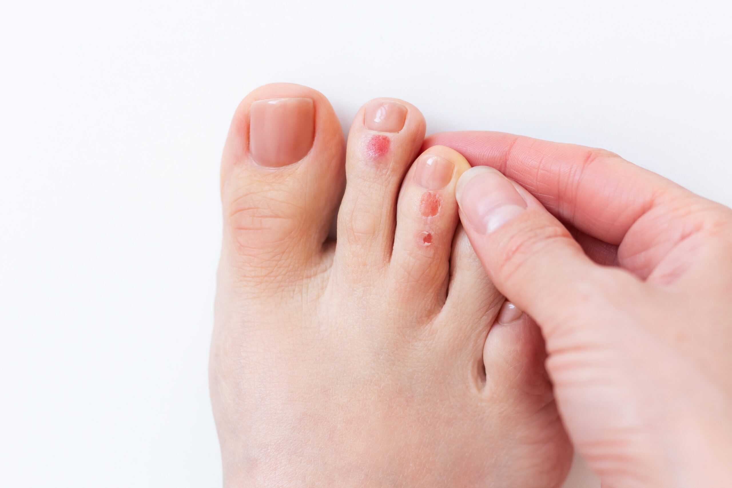 Heel Pain Calcaneal Spurs