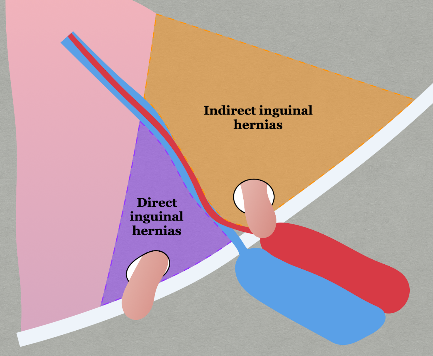Hernias In Women