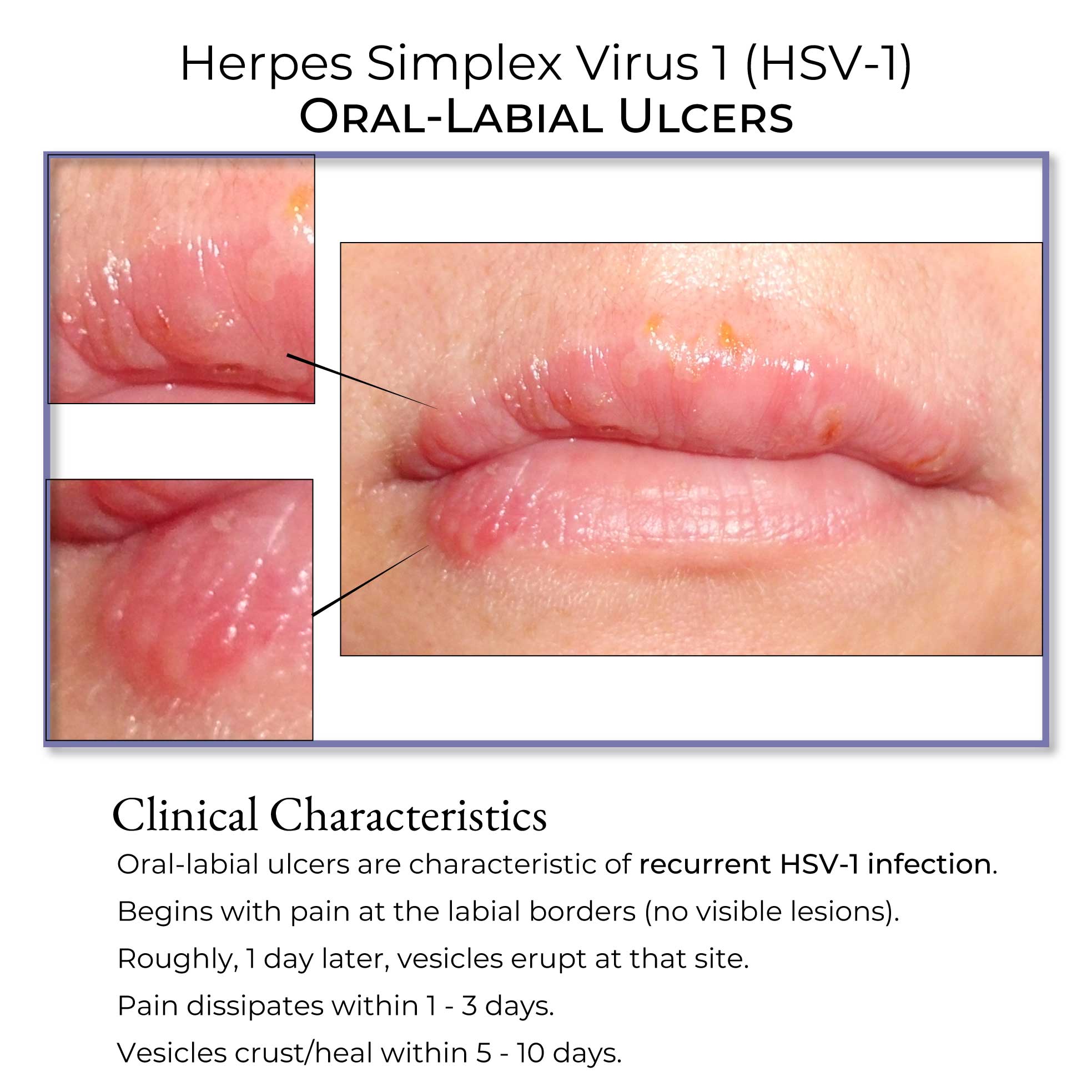 Herpes Fordyce Spots