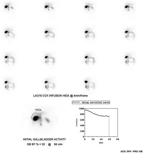 Hida Scan Cost