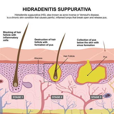 Hidradenitis Suppurativa Specialists