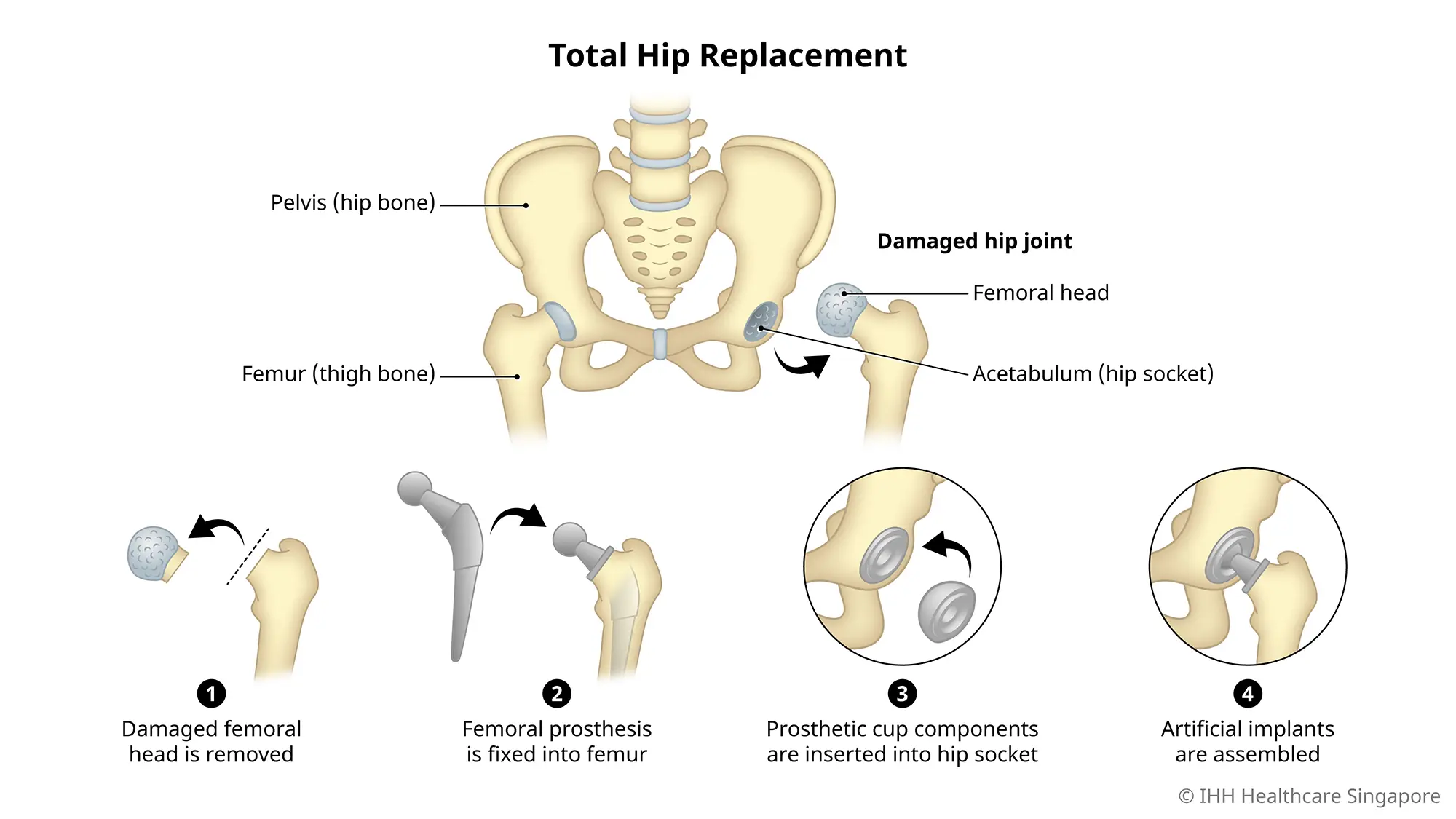 Hip Stress Fracture