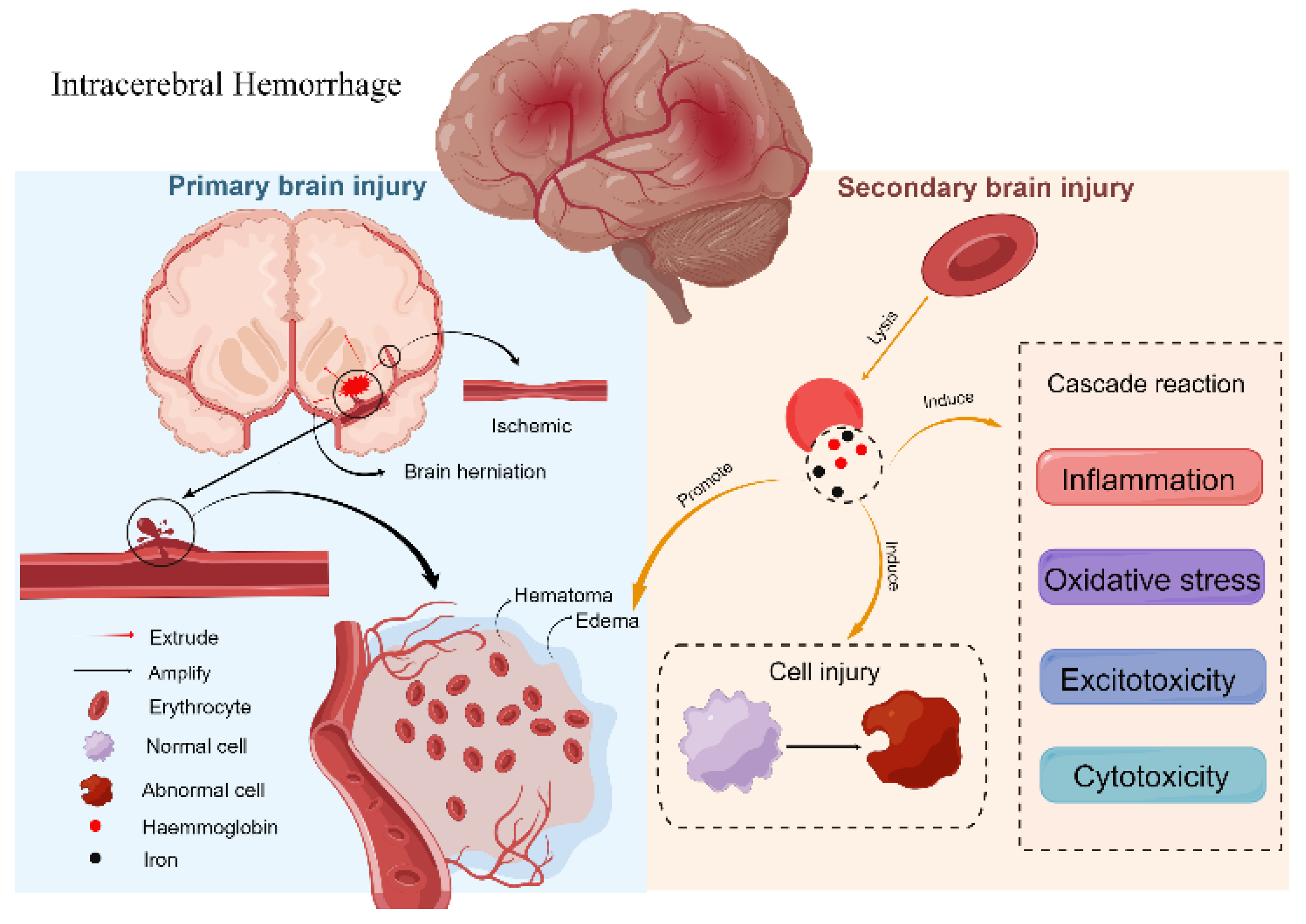 How A Brain Haemorrhage Causes Death: Understanding The Risks