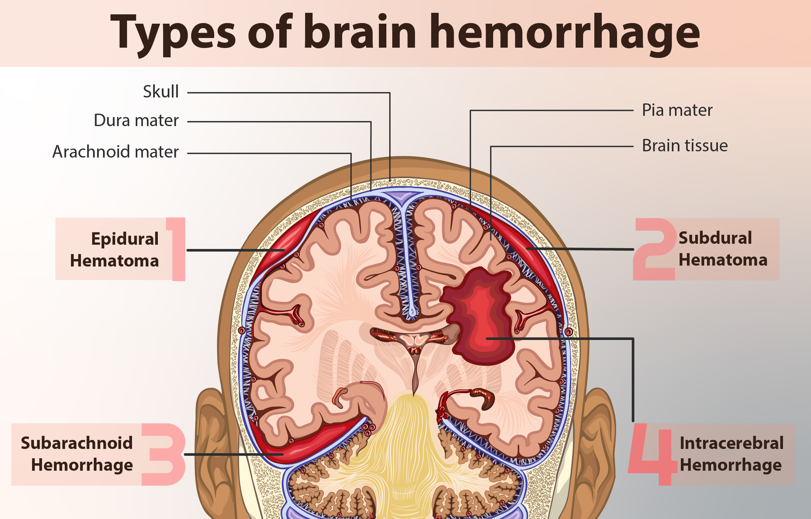 Understanding How A Brain Hemorrhage Happens: Causes And Risks