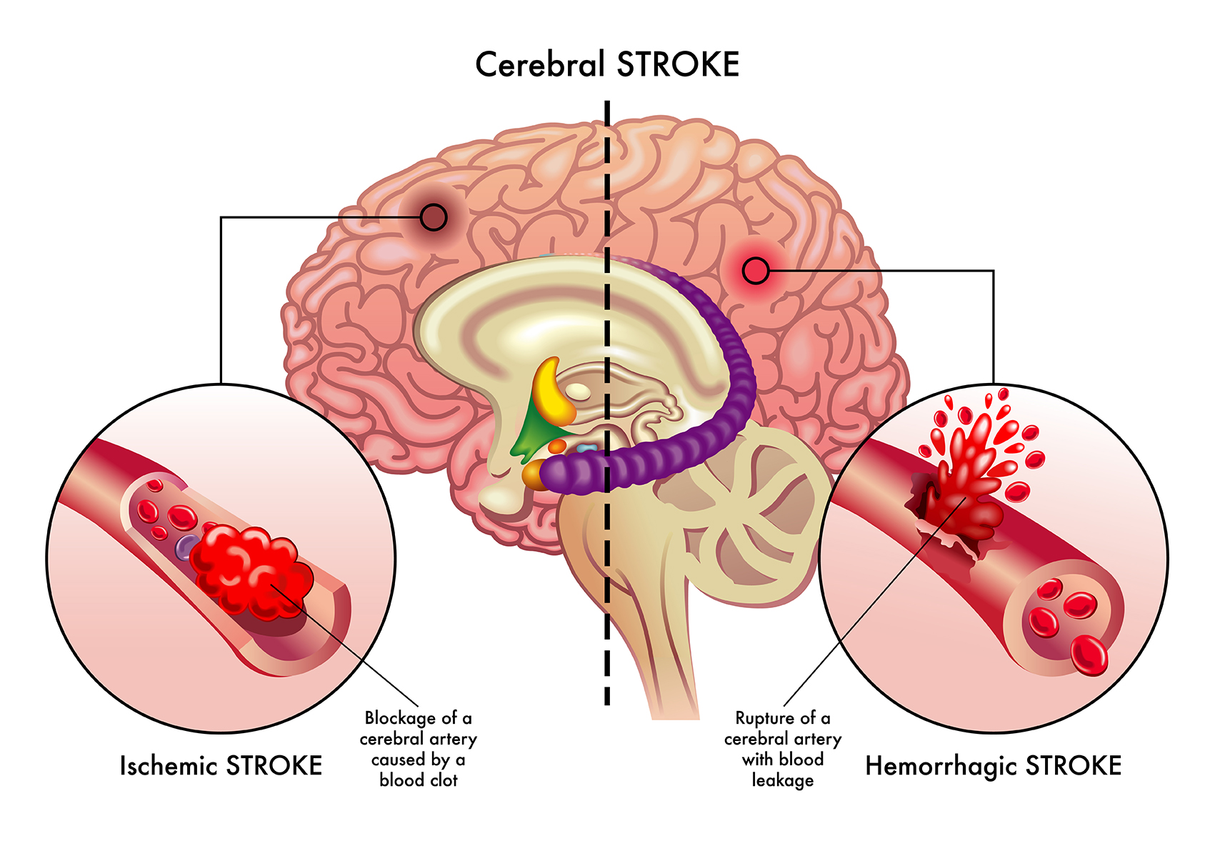 Understanding How Brain Stroke Happens: A Clear Guide