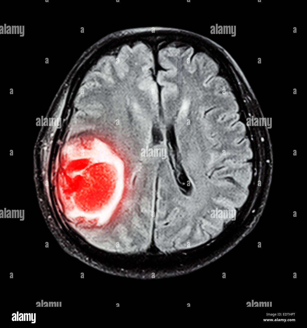 What Does A Brain Tumor Look Like On An Mri Scan?
