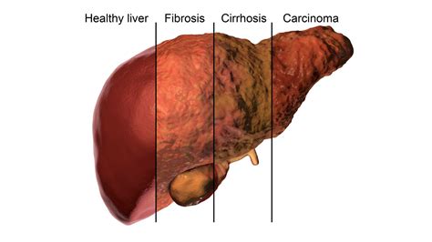 How Common Is Fatty Liver