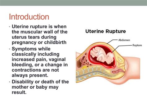 How Common Is Uterine Rupture