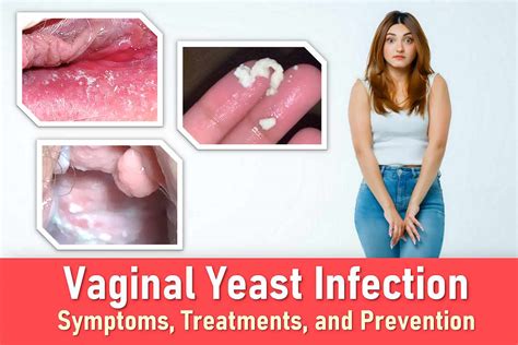 How Common Is Yeast Infection In Women