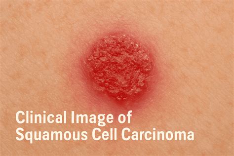How Dangerous Is Squamous Cell Carcinoma