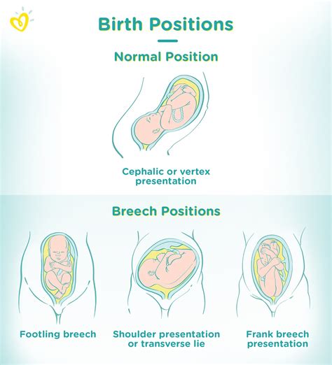 How Do They Move A Breech Baby