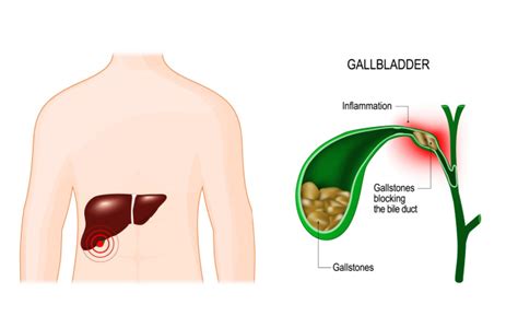 How Do You Get Gallstones