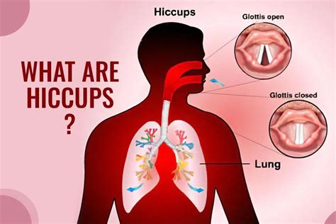 How Does Hiccups Happen