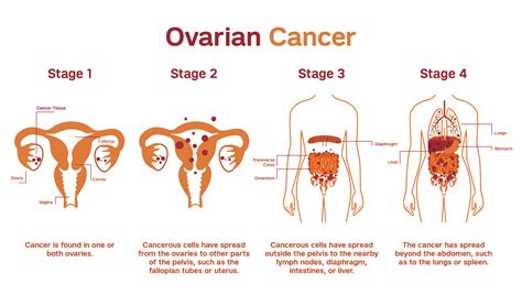 How Fast Can Ovarian Cancer Grow