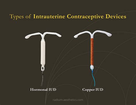 How Long Does Iud Last