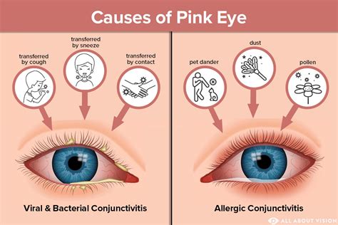 How Long Is Viral Pink Eye Contagious