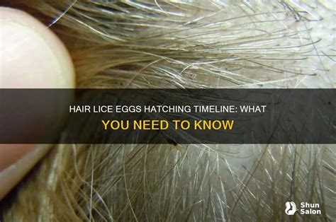 How Long Until Lice Eggs Hatch