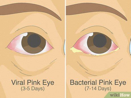 How Long Until Pink Eye Goes Away