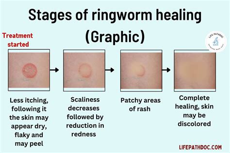 How Long Until Ringworm Goes Away