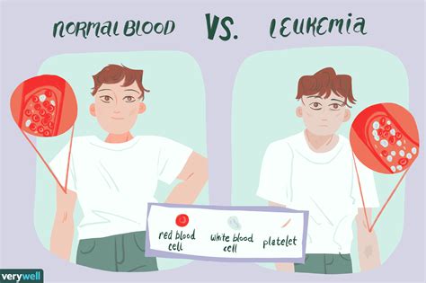 How To Check For Leukemia