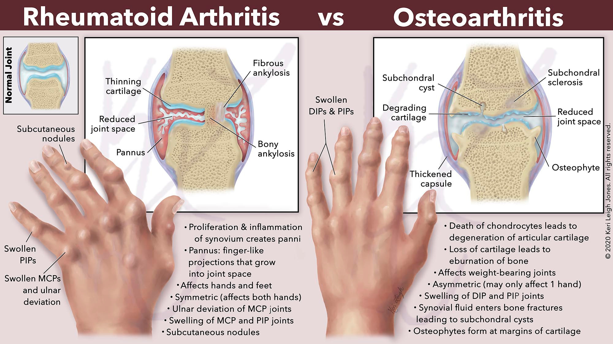 Rheumatoid Vs. Osteoarthritis: How To Distinguish The Two