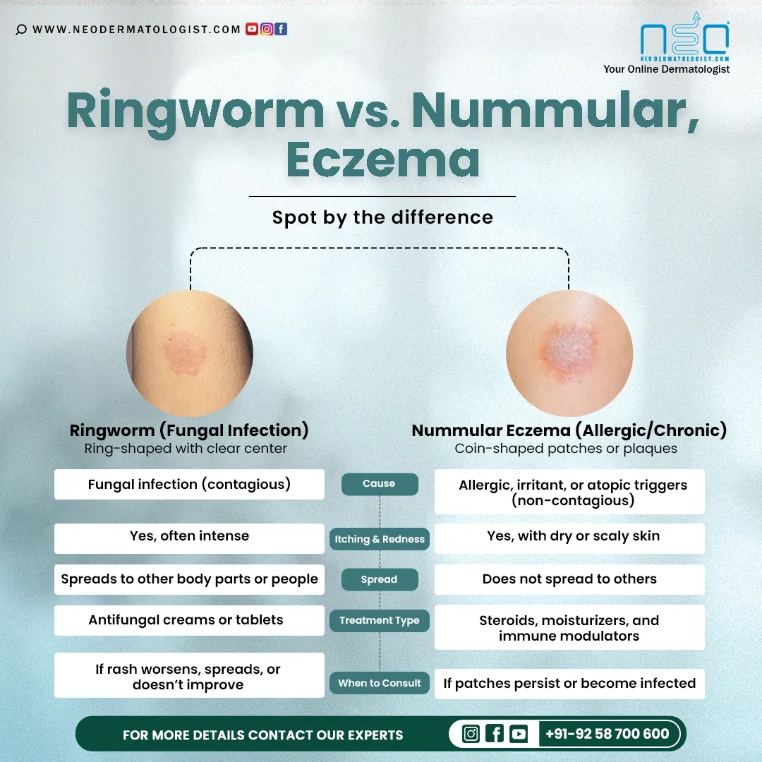 How To Distinguish Ringworm From Eczema: A Clear Guide