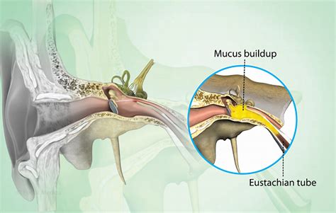 How To Drain Eustachian Tube