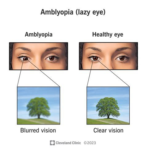 How To Fix Amblyopia