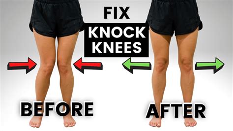How To Fix Knock Knees