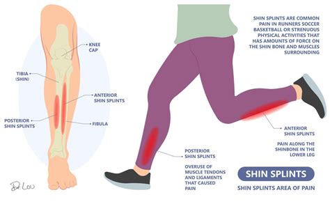 How To Fix Shin Splints