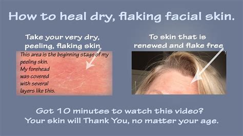 How To Heal Dry Face
