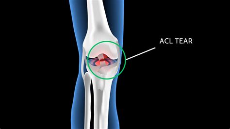 How To Prevent Acl Tears