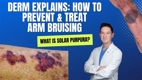 How To Reduce Bruising