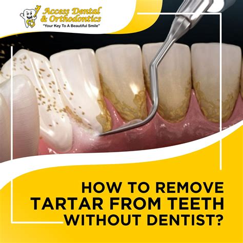 How To Remove Tartar
