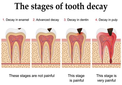 How To Reverse Tooth Decay